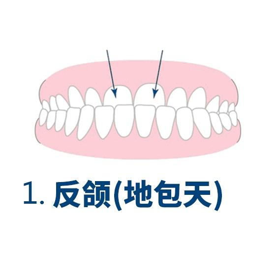 牙性和骨性反颌示意图图片