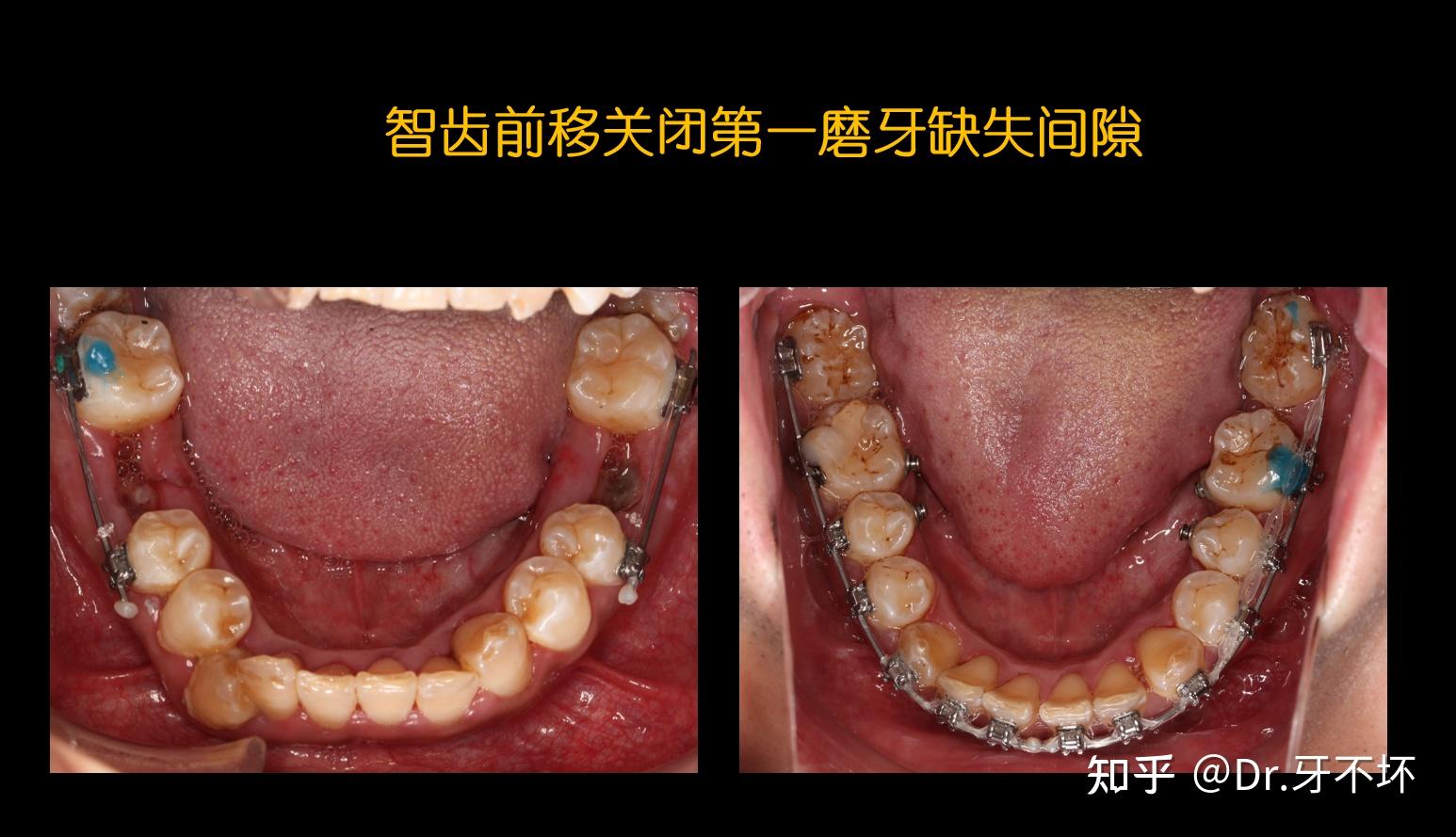 6号牙全废了能用5号牙能吃饭嘛? - 知乎