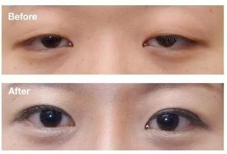 如何判断双眼皮和眼皮松弛