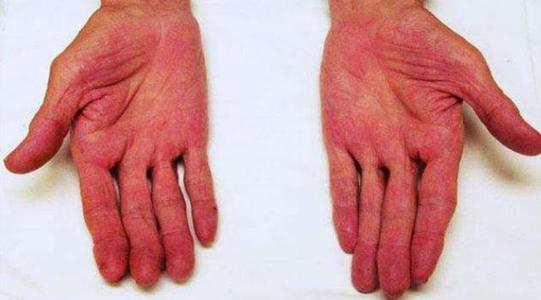 出现肝掌是不是很严重