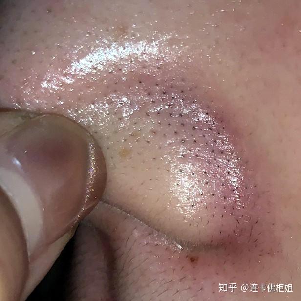 毳毛黑头怎么去呀? - 知乎