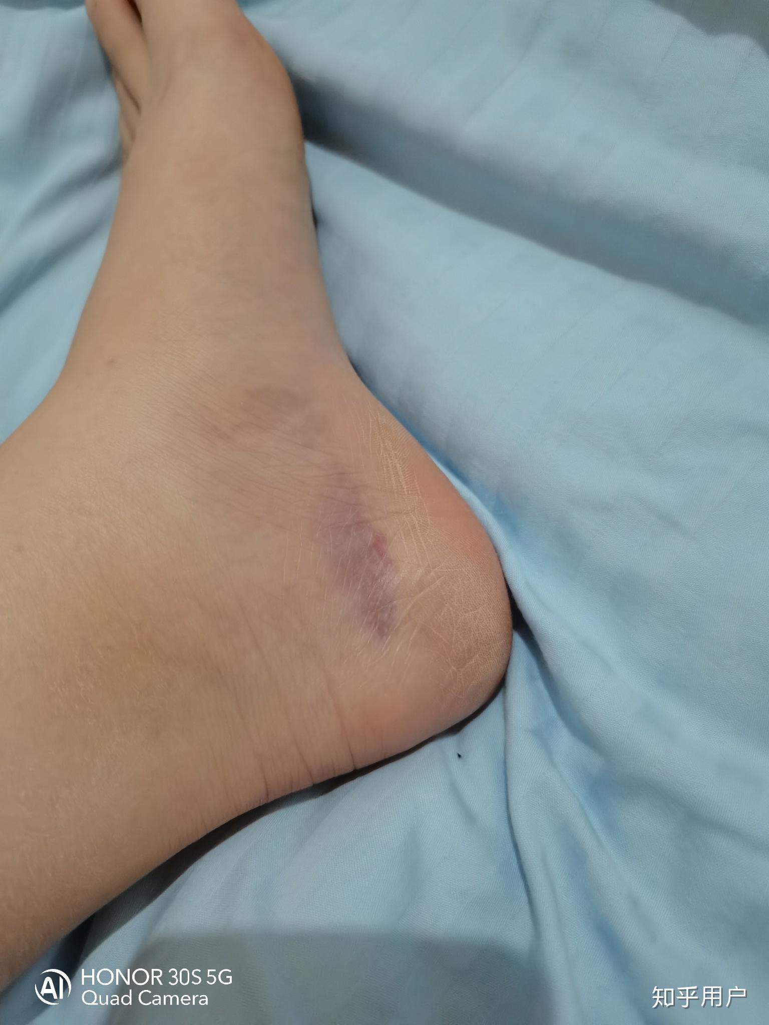 脚崴了快速好起来的最好方法? - 知乎