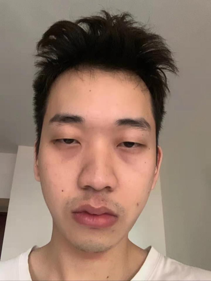 男生黑眼圈重怎么办? - 知乎