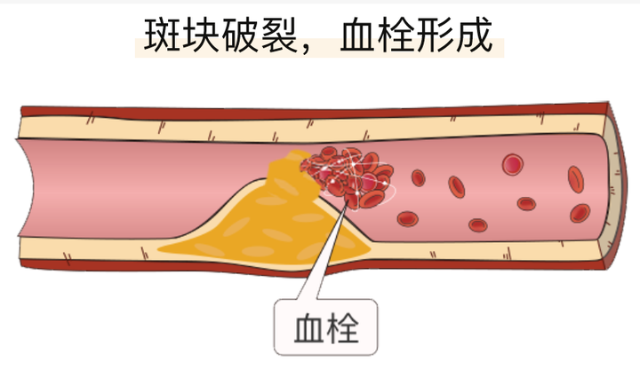 血栓是怎样形成的? - 知乎