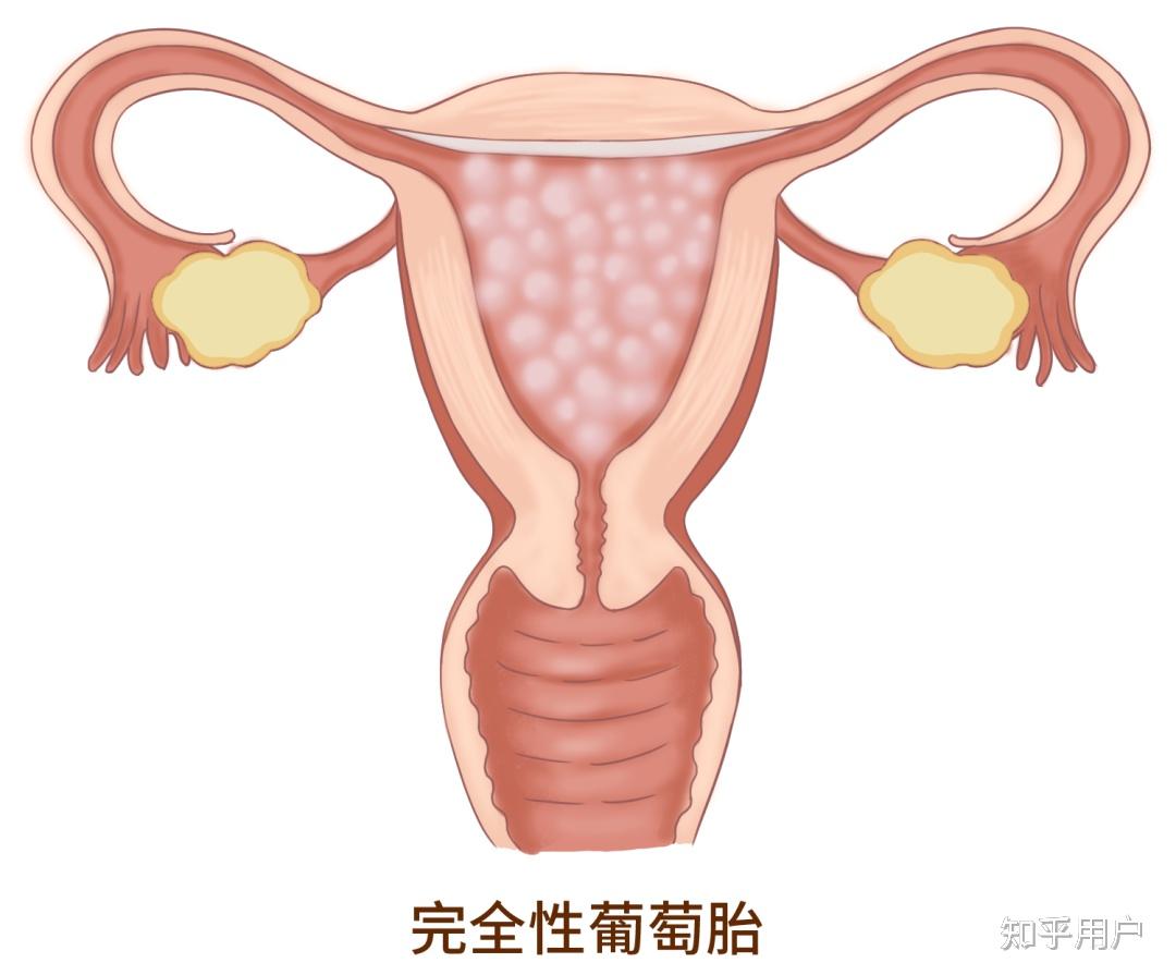 怀了葡萄胎有哪些特征?
