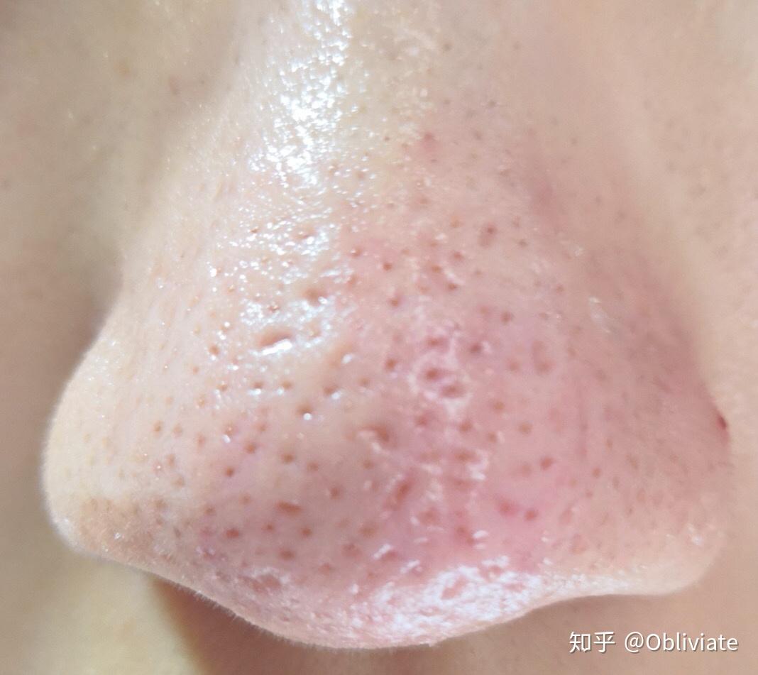 挤黑头应该如何处理留下的洞洞? - 知乎