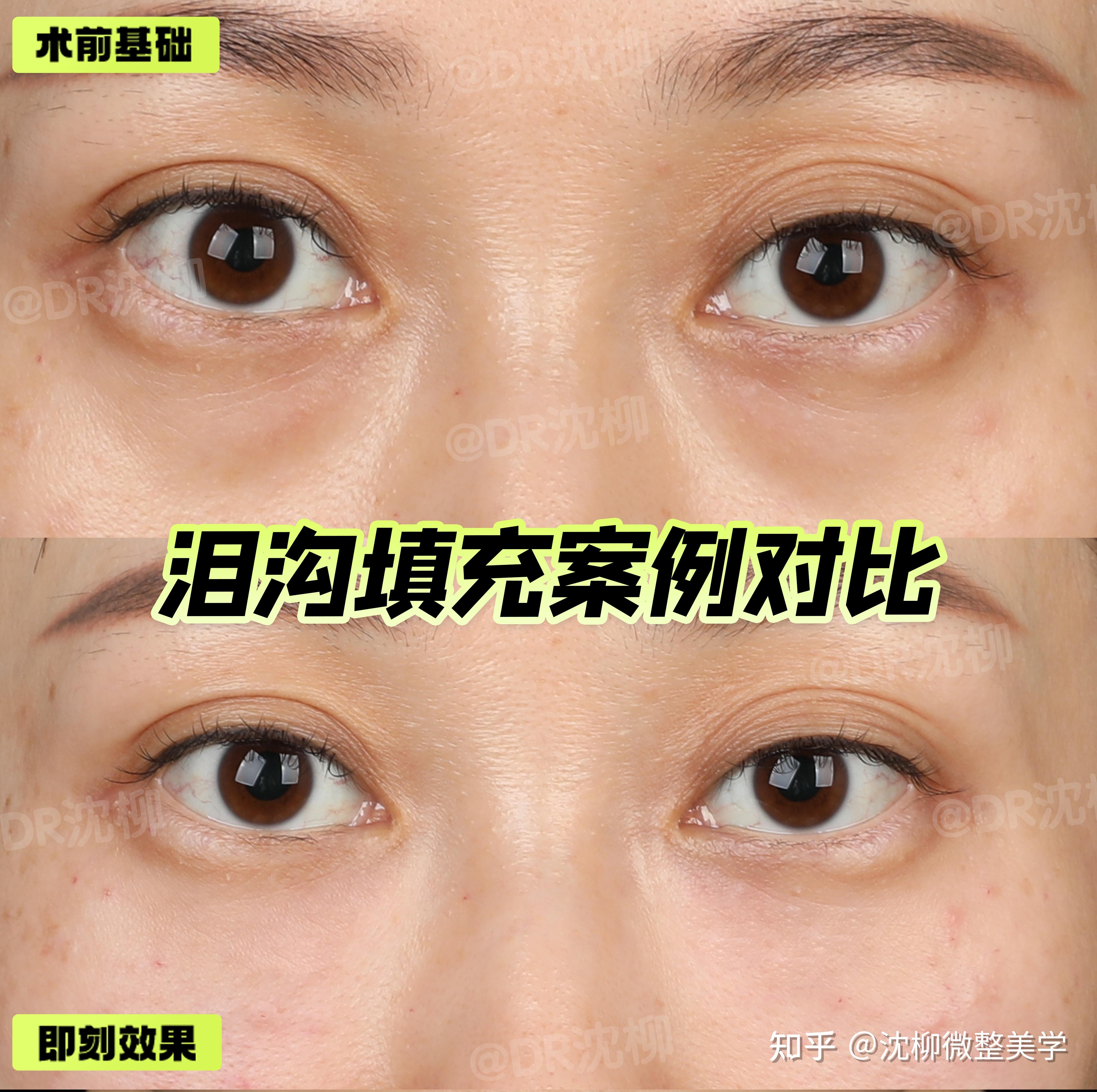 眼睛下面有一条线究竟是什么求解 眼睛下面有一条线究竟是什么求解