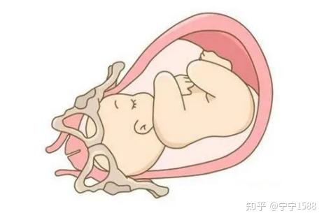 孕妈注意啦,有这7种感觉可能是胎儿入盆了~ - 知乎