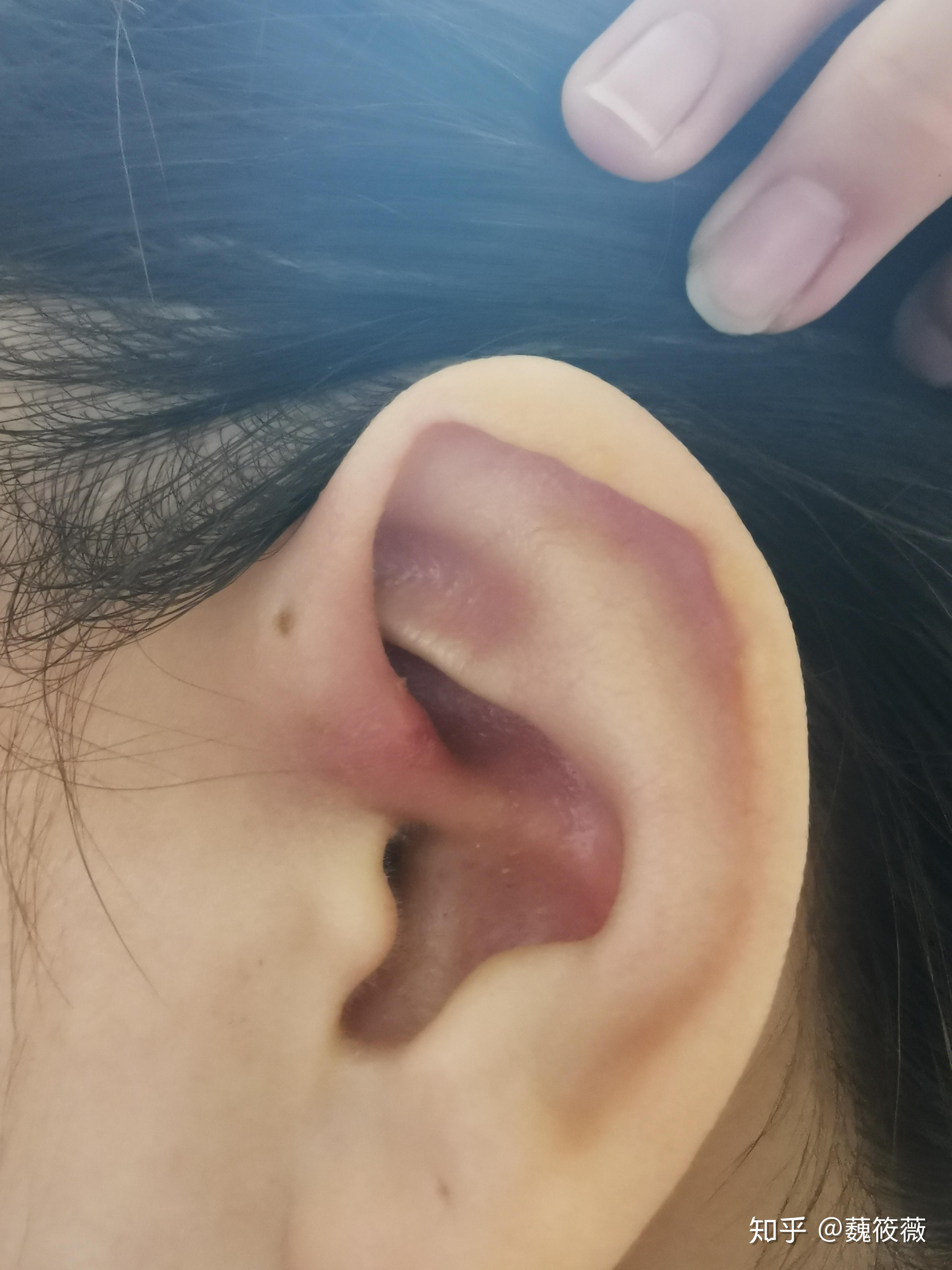 患有先天性耳前瘘管是一种怎样的体验