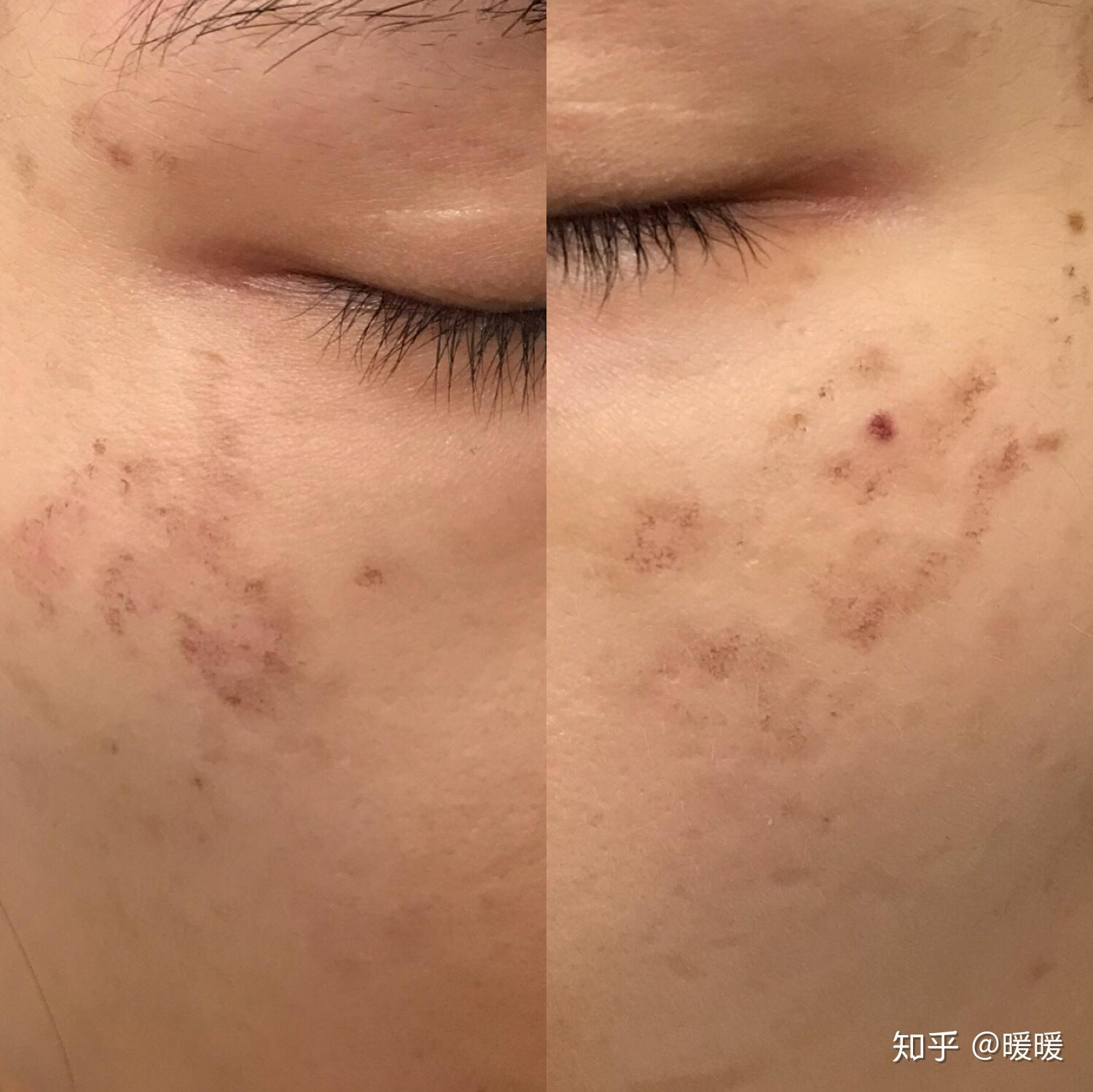 颧骨上长出来的斑是和身体的什么有关系? - 知乎