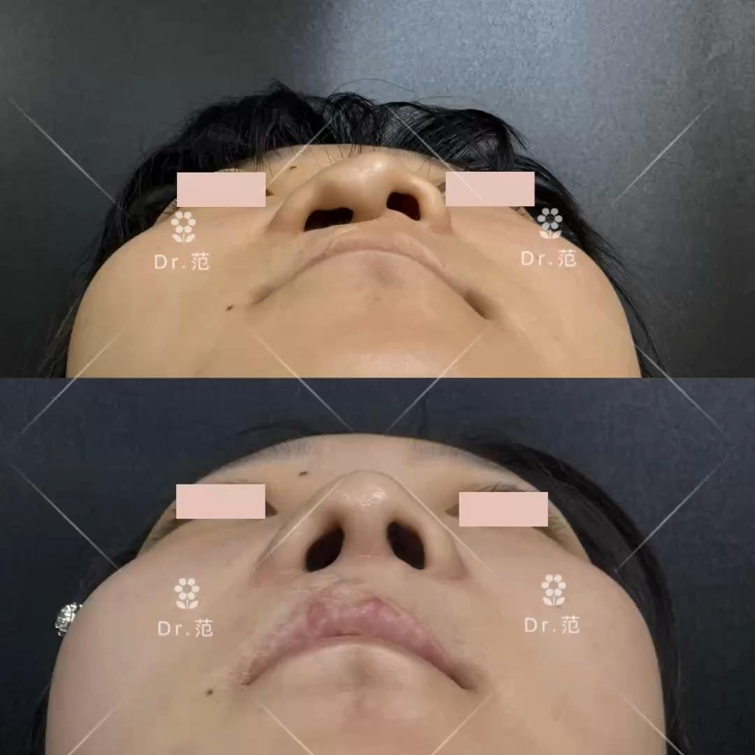 唇裂鼻修复