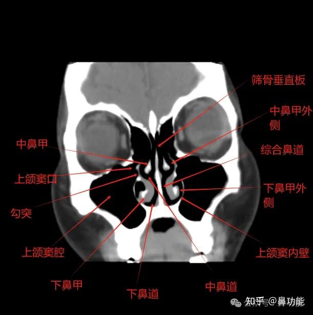 鼻窦 CT 各部位名称解析与鼻腔解剖基础知识 - 知乎