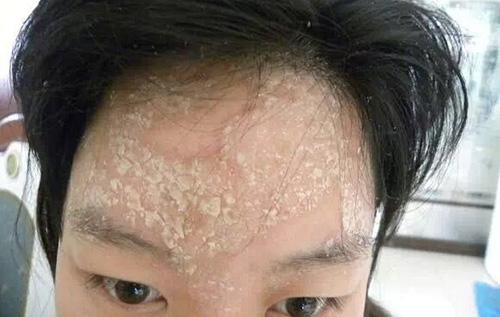 脸上长了牛皮癣怎么办?