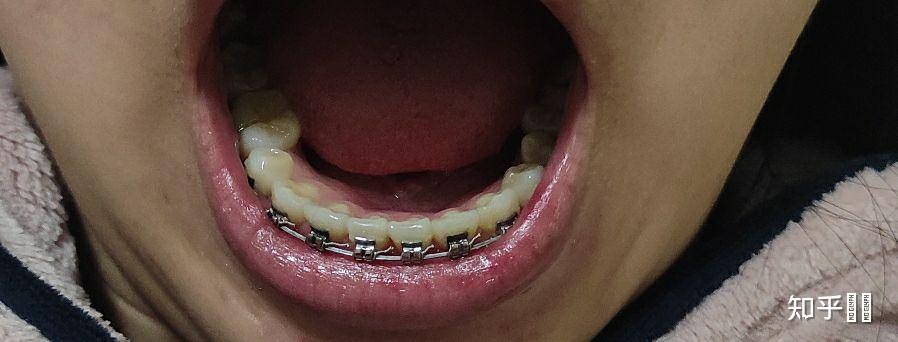 有没有5号牙拔掉后好多年不管的现在怎么样了