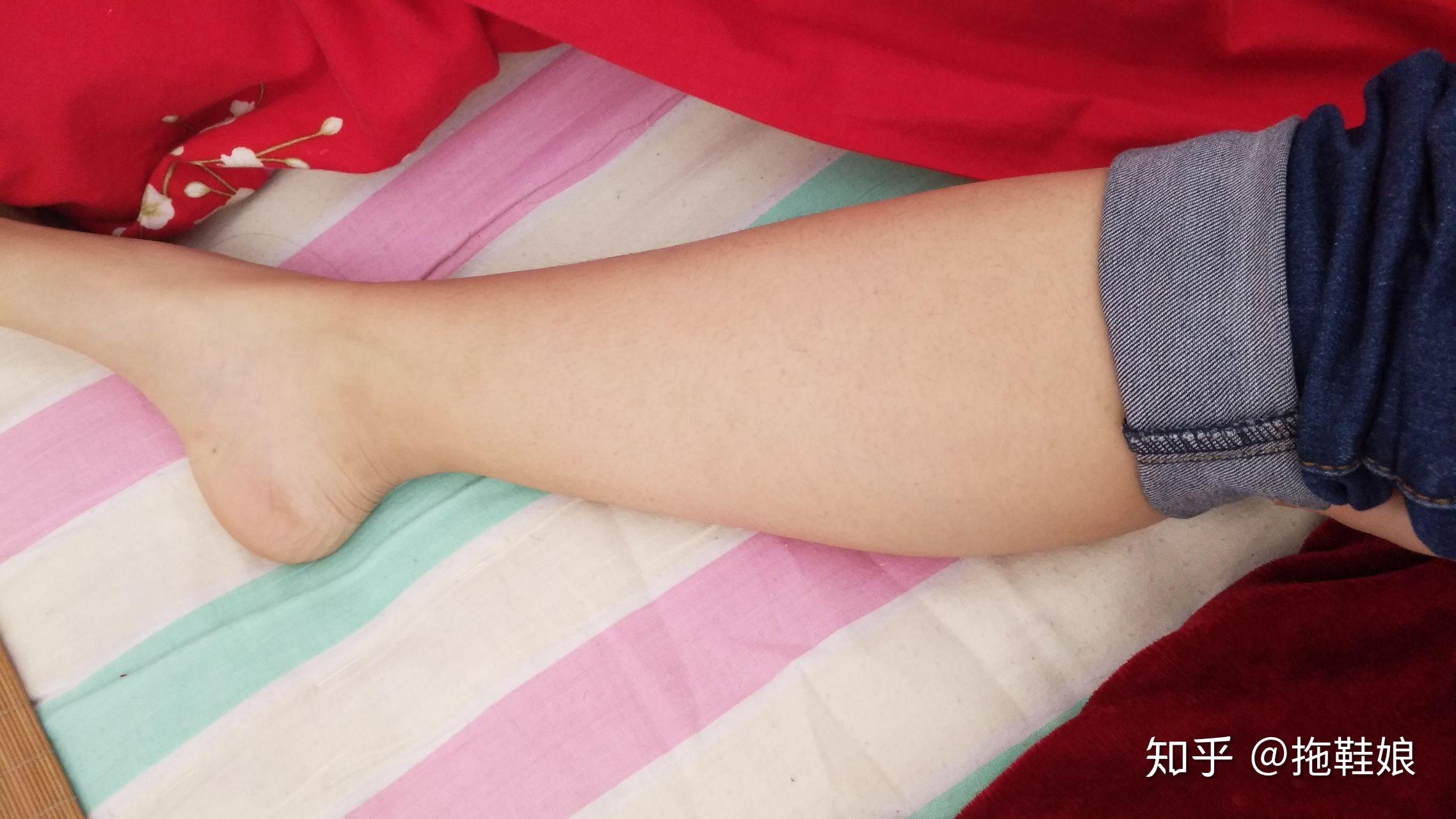 跟腱太短怎么办