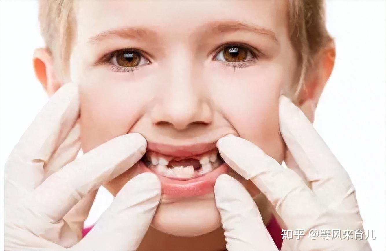 儿童龋齿蛀牙危害多，牙刷还是专业分龄的好，瑞吉鸥儿童牙刷好用 - 知乎