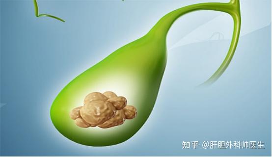 医学科普-胆囊结石和胆囊炎,你知道多少? - 知乎