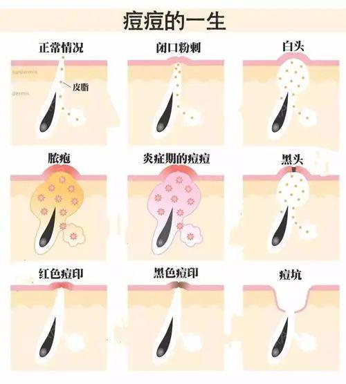 6个有效淡化痘印的医美项目,你清楚了吗? - 知乎