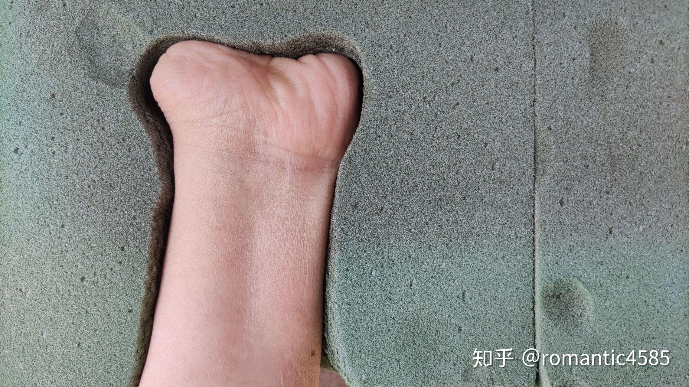 手残疾,只生一个手掌,可以安装肌电假肢吗?