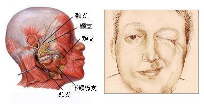 面肌痉挛左侧面部抽搐十年面部肌肉跳动严重时眼睛睁不开