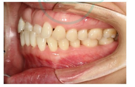 上下大牙咬合不正医生建议使用扩弓器先扩上牙再用上牙牵引下牙这个