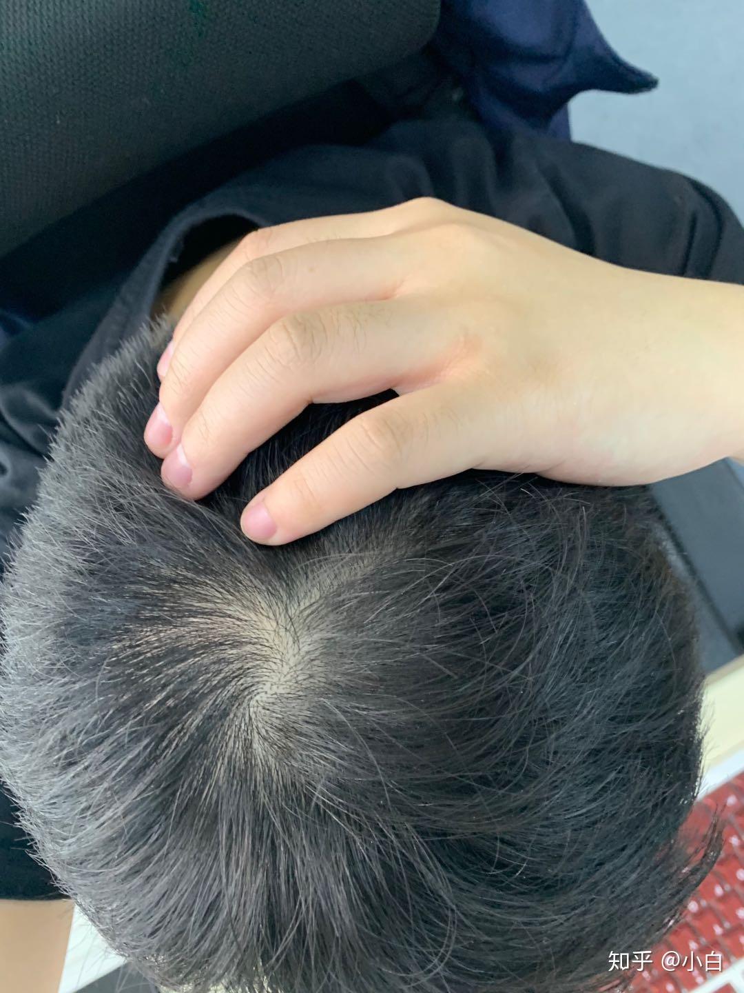 我这头顶漩涡处头发量正常吗? - 知乎