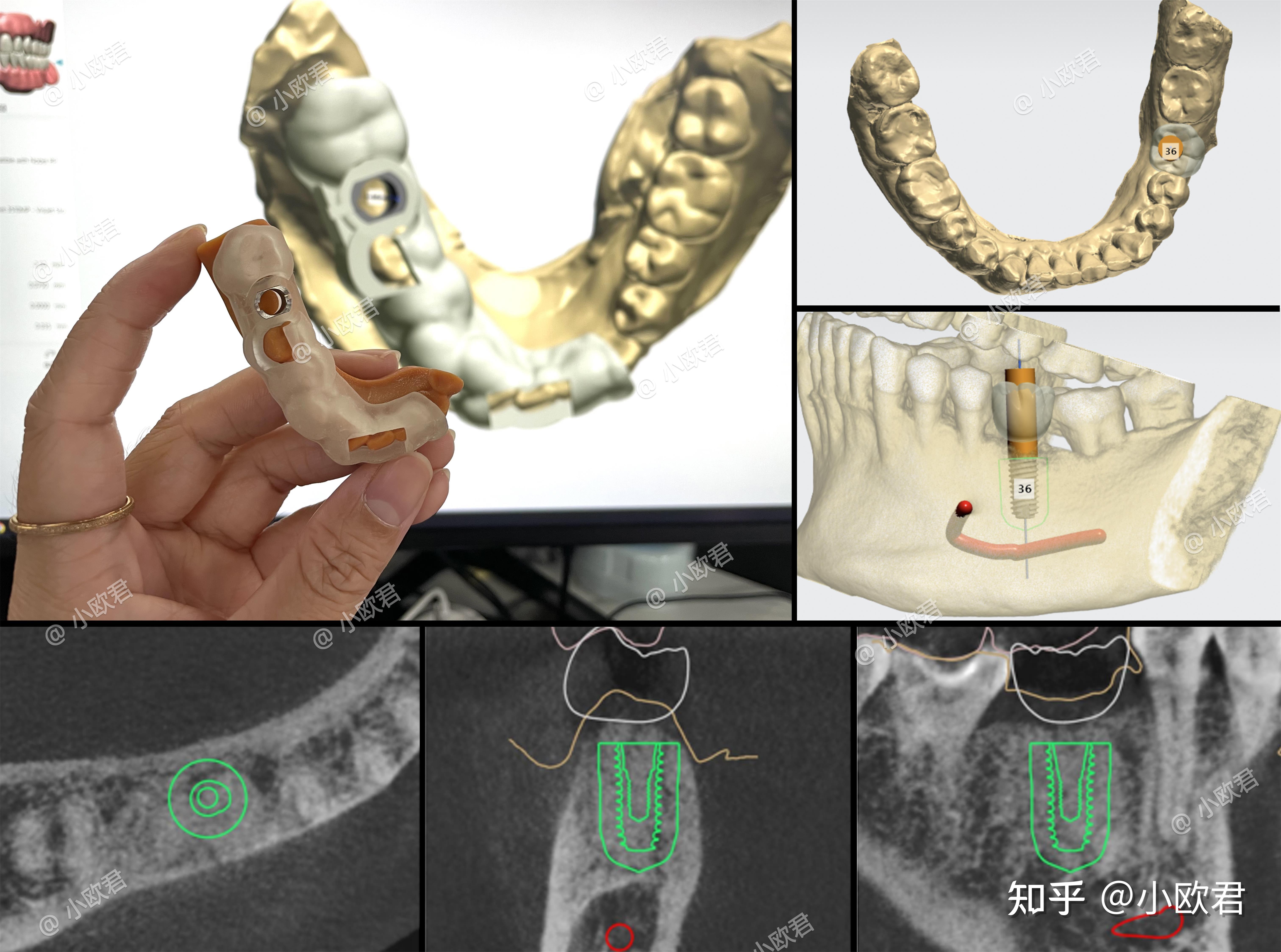 3d导板种牙和普通种牙的区别