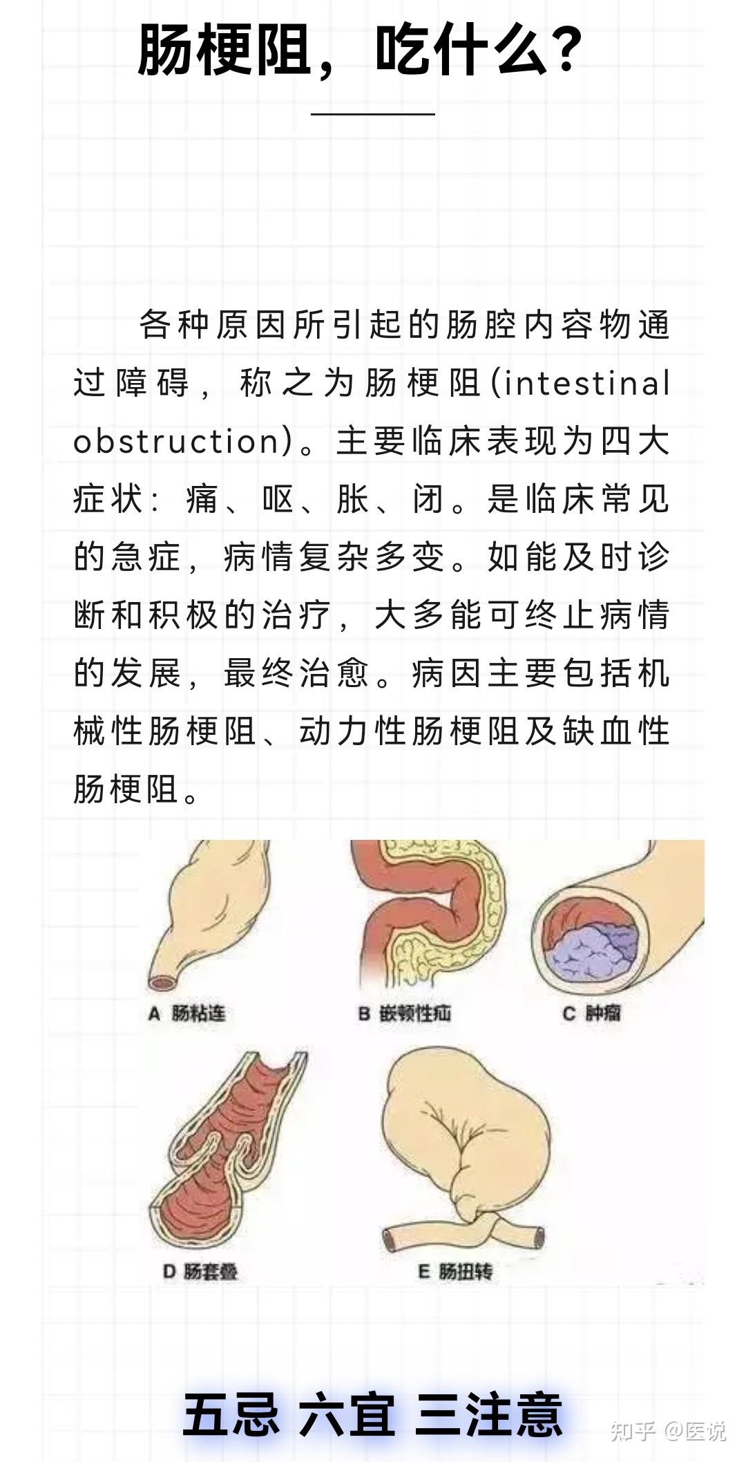 动力性肠梗阻图片图片