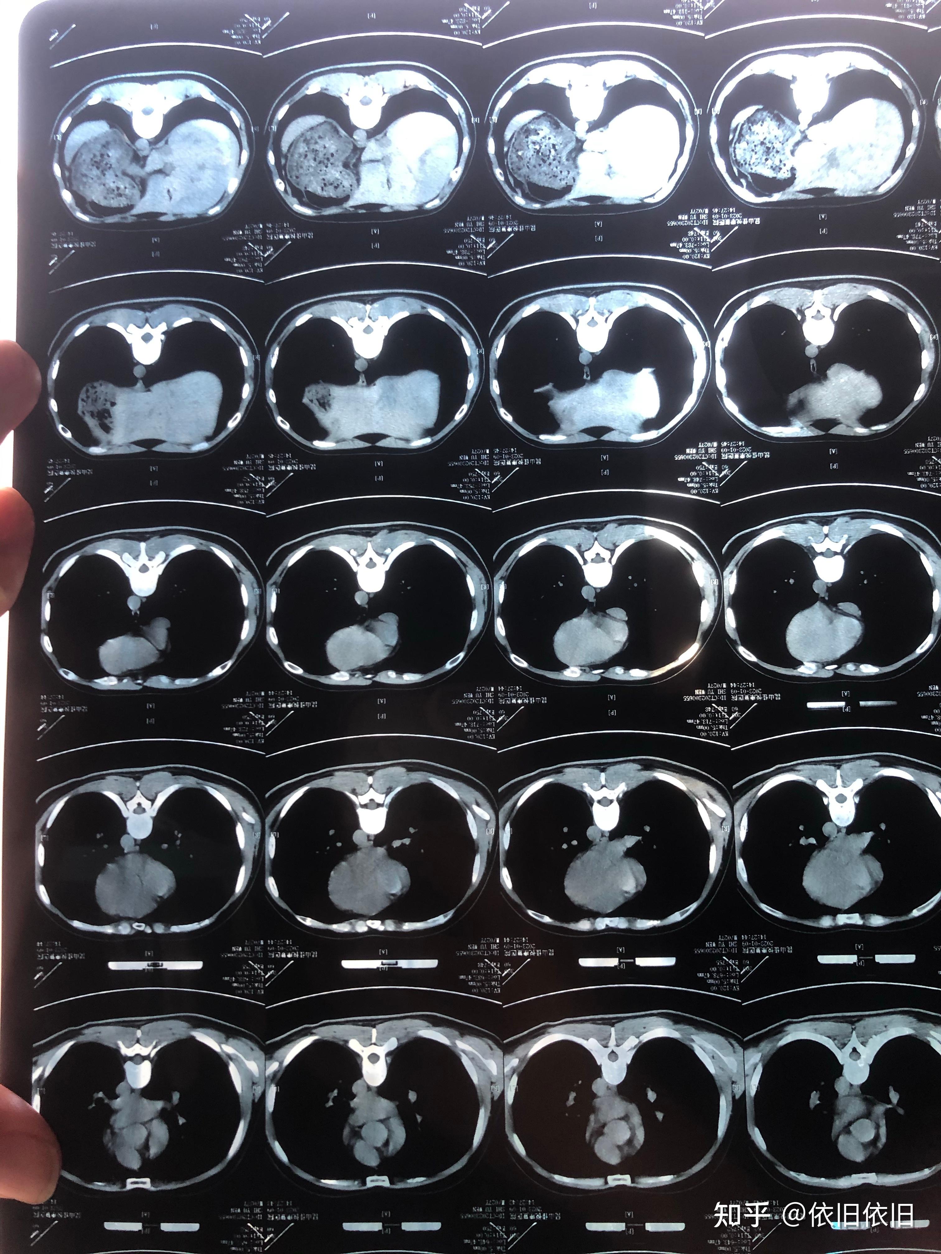 怎么看待这次一部分阳了之后的病人,去医院拍了个胸部ct,发现得了肺炎