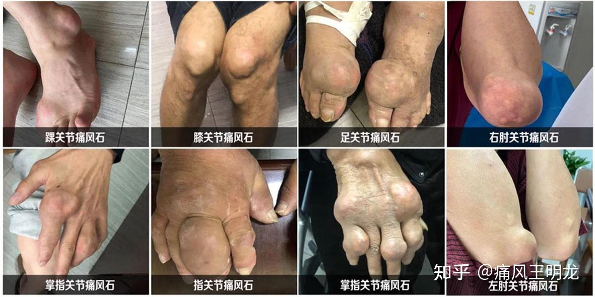 左脚无名脚趾肿痛是痛风吗? - 知乎