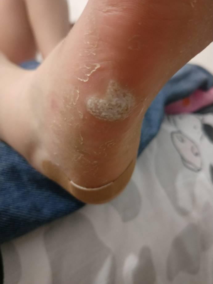 跖疣可以自愈吗?