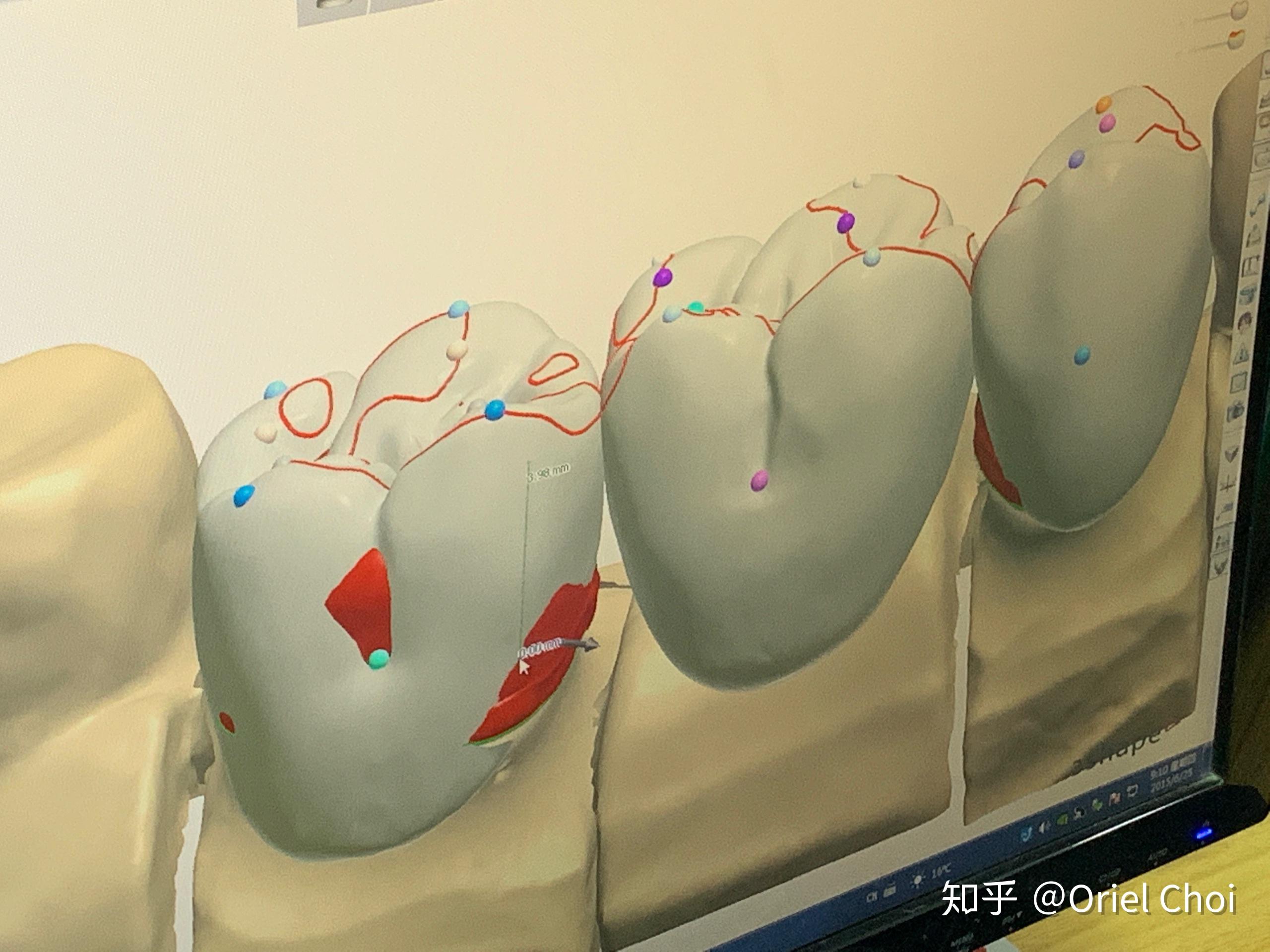 hawley保持器医生手工做和工厂做哪个好? - 知乎