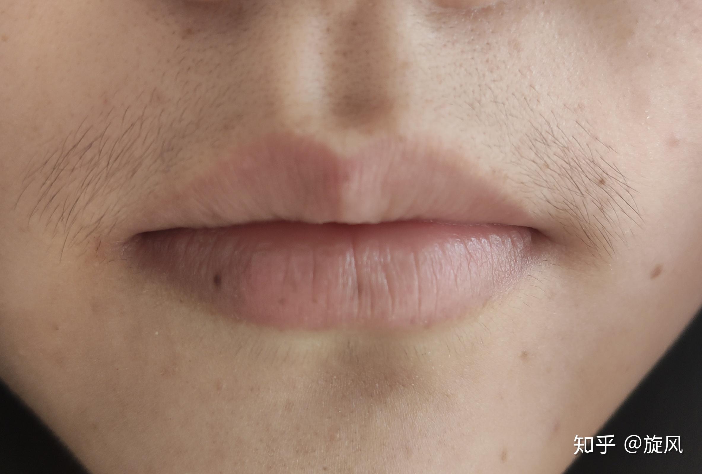 冰点脱毛仪脱唇毛效果如何