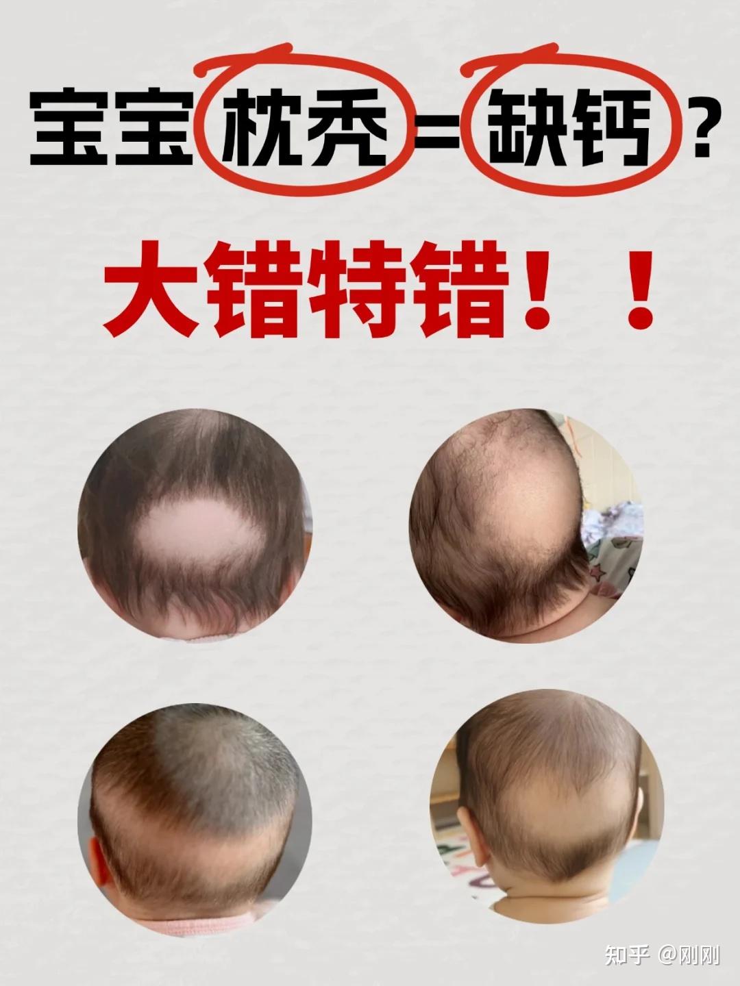 宝宝枕秃的真相,一分钟快速读懂 - 知乎