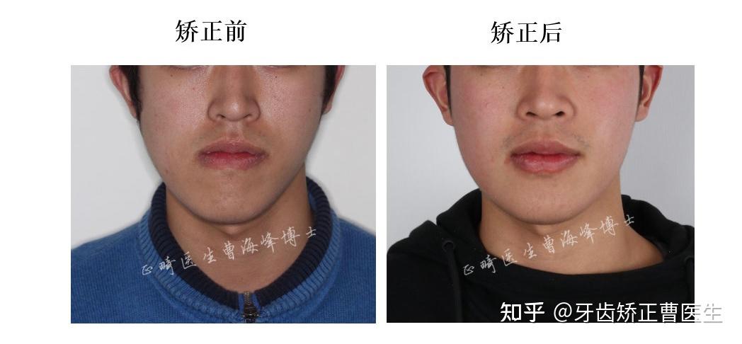 下颌骨偏颌(下巴那边歪)快成年了还可以矫正吗? - 知乎