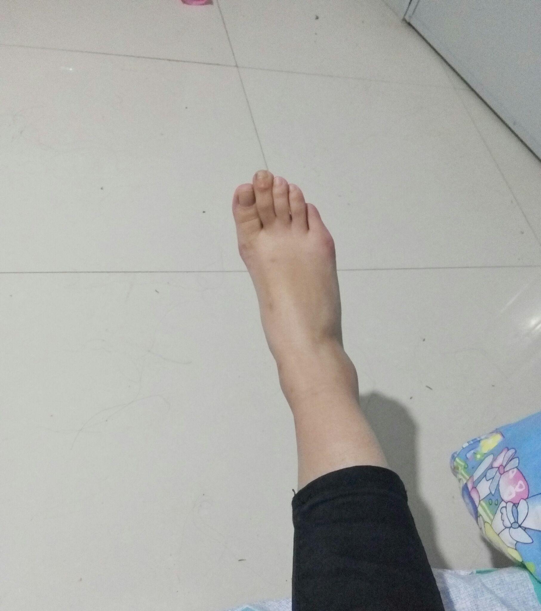 脚趾中的二趾特别长有什么不便的地方