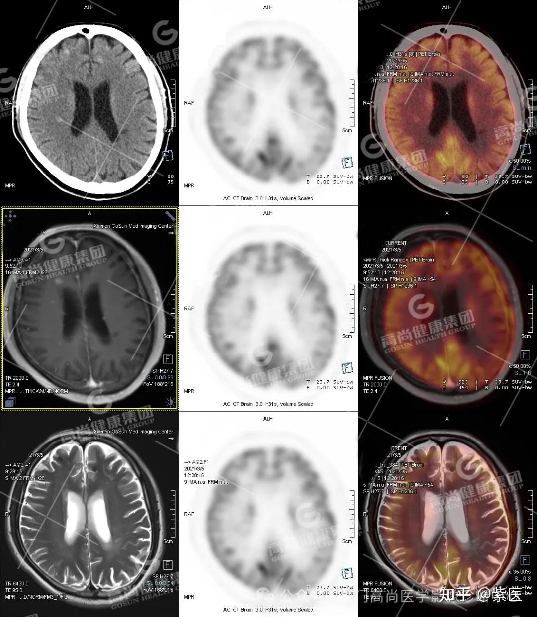 PET/CT-MR 多模态融合技术在临床中的应用病例分享（一） - 知乎