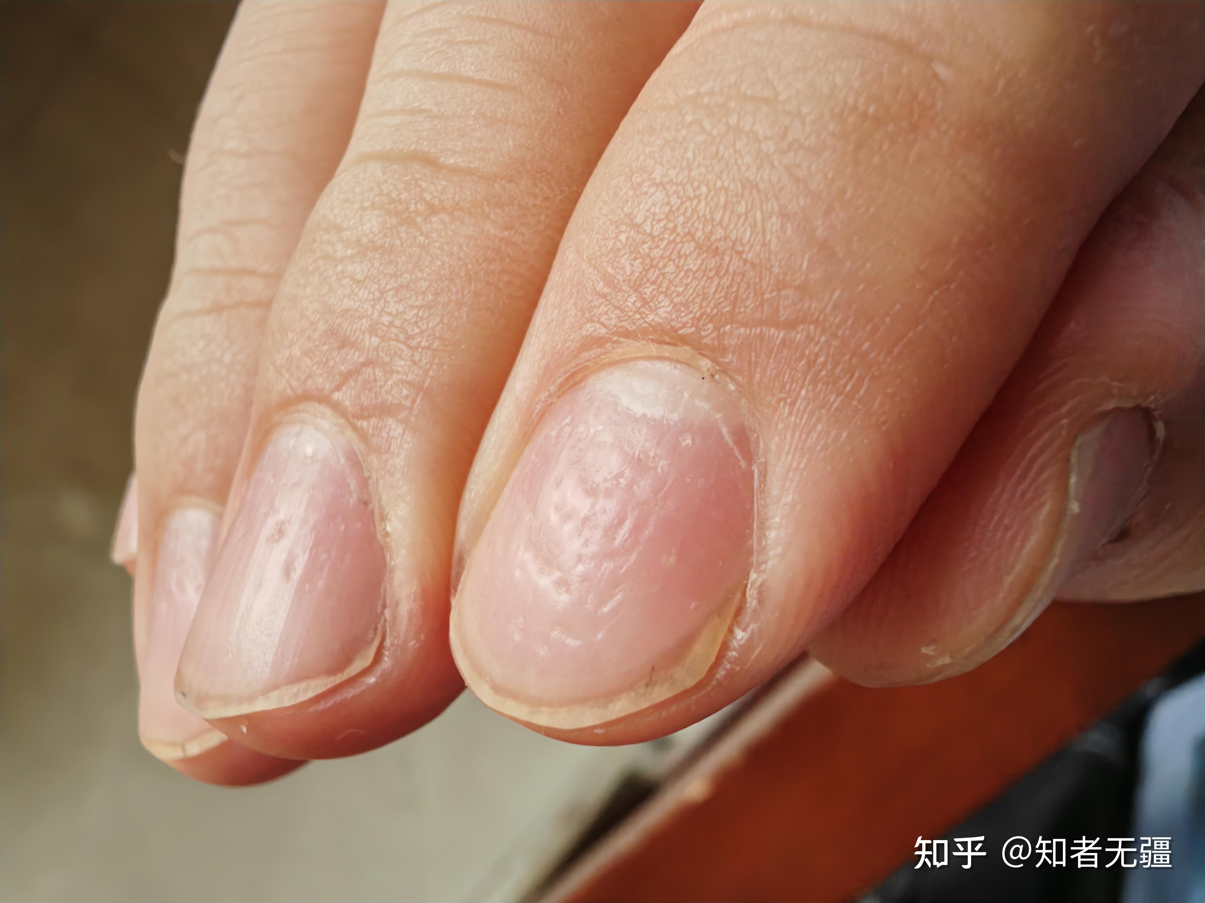 手指甲上全是小坑是怎么回事呢?