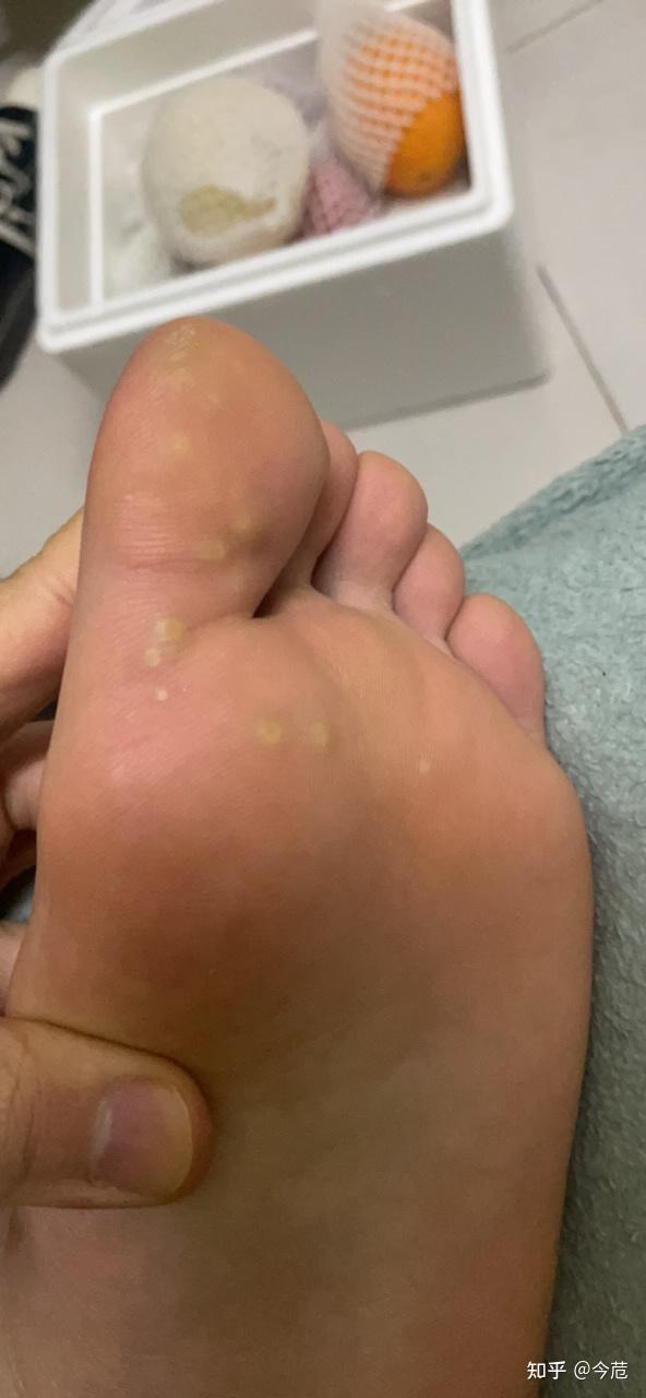 大二学生发现脚底长了跖疣从最开始的三个到现在已经有十几颗了之前不