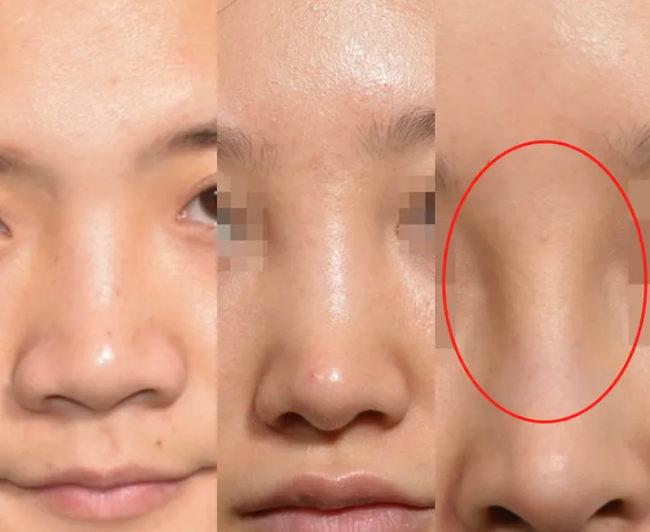 玻尿酸注射鼻子真的会变宽(有图有真相)