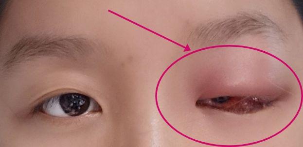 一只眼睛上眼皮和眼角突然肿了这是为什么