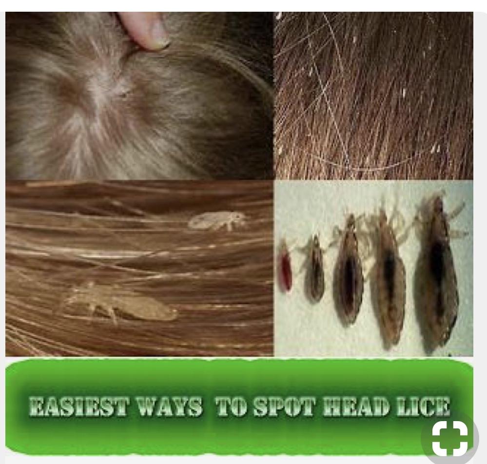 理发师说头发经常绑着容易出现毛管虫,毛管虫是什么来的?