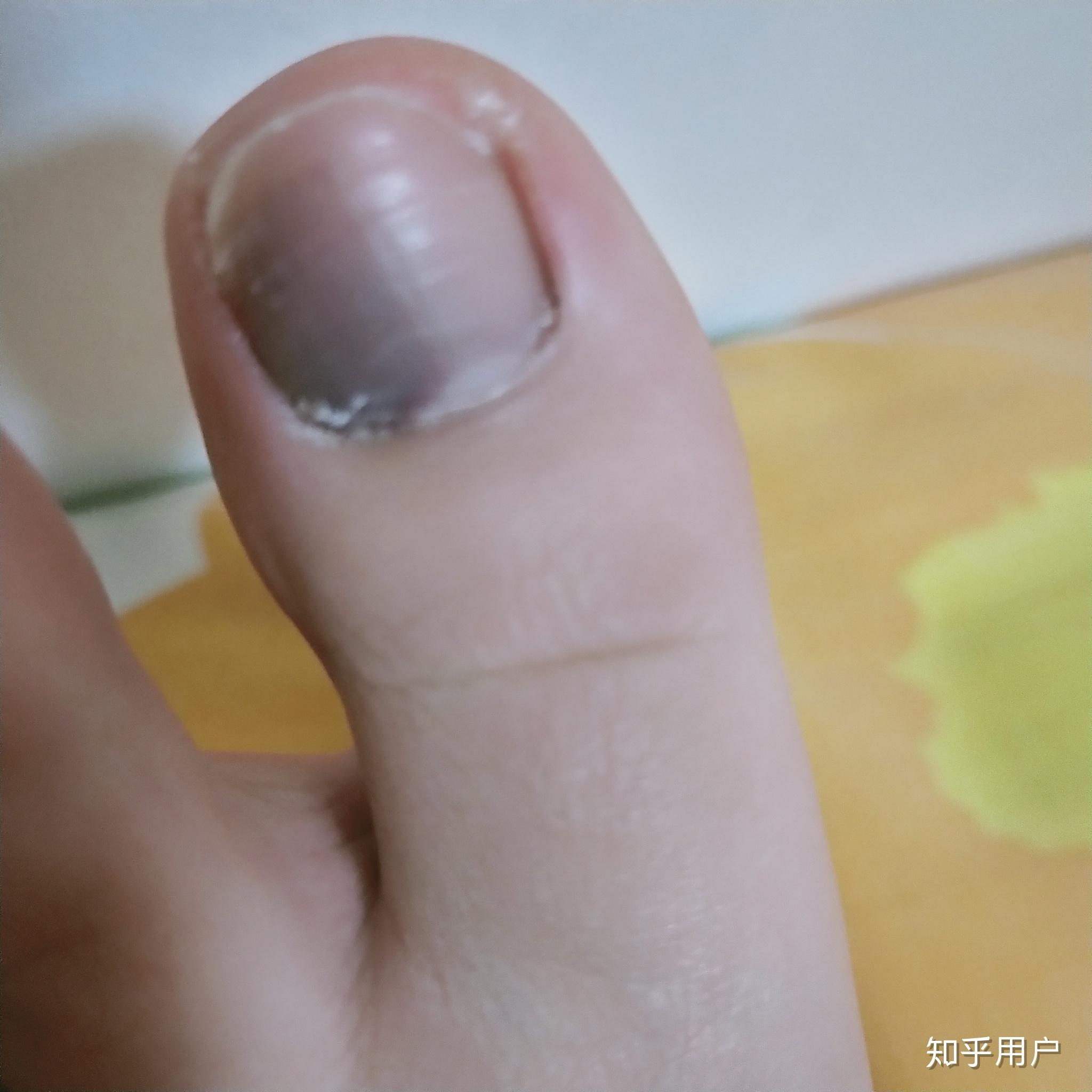 请问这是甲下淤血吗