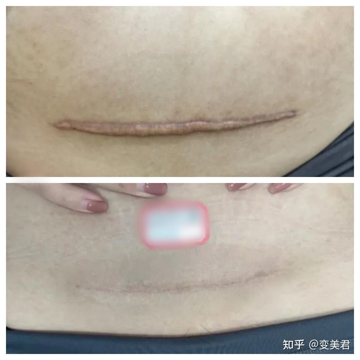 【剖腹产的姐妹必看!】只要找准了剖腹产疤痕修复思路及方法,剖腹产后一直难看的疤痕也是有办法搞定滴!