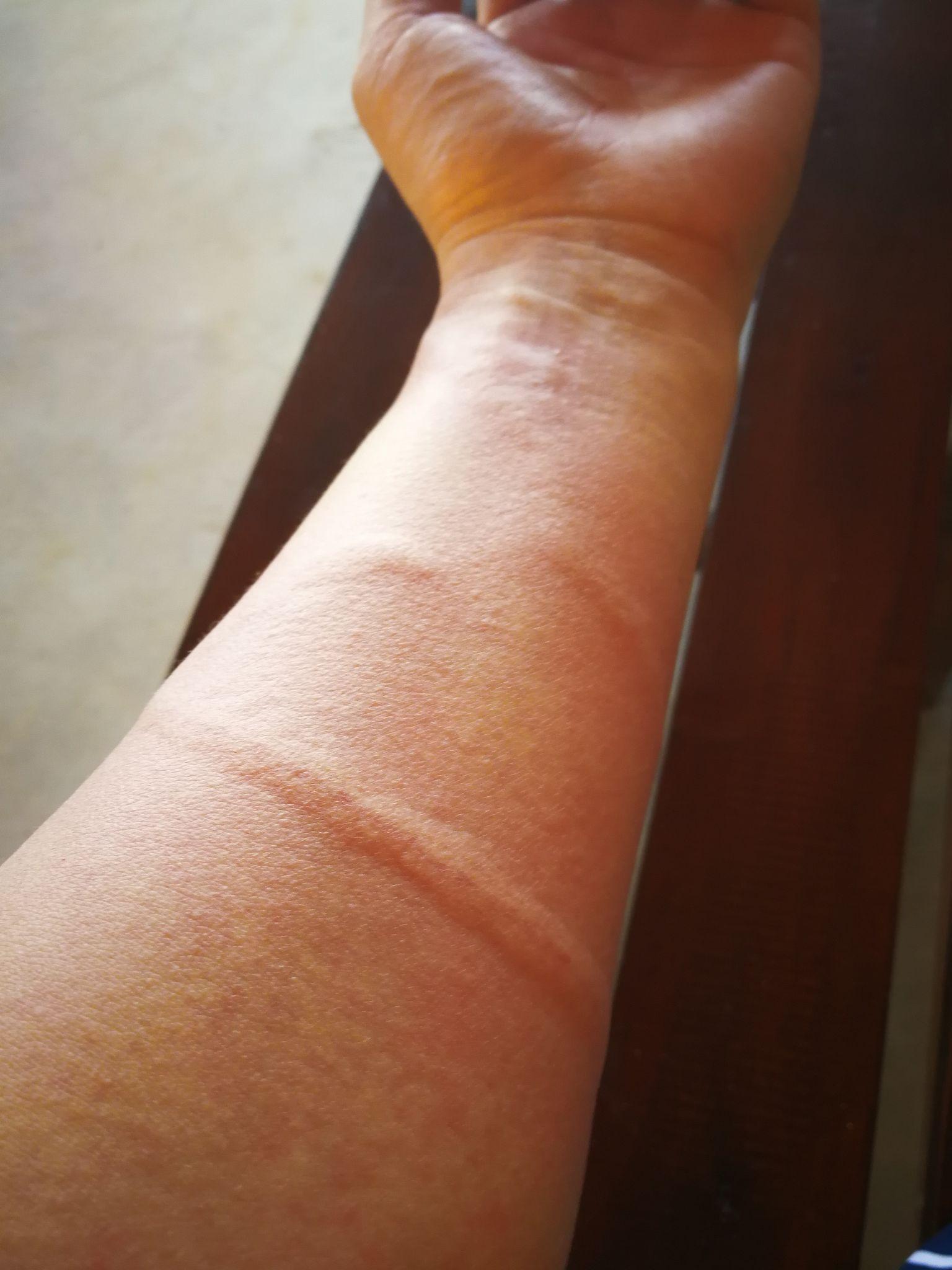 被水母蛰是一种什么体验?