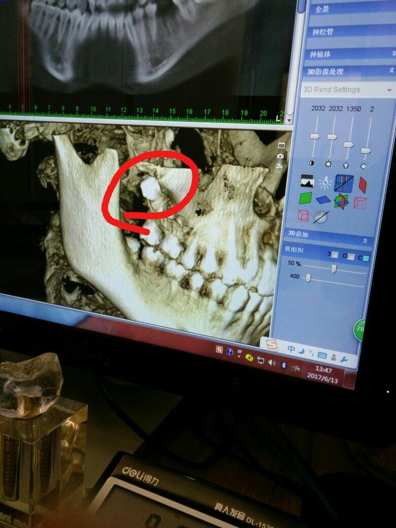 上边这两个智齿是长脸上去了吗? - 知乎