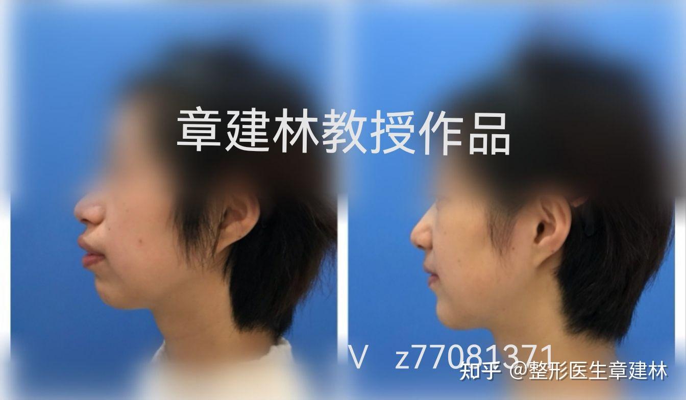 正颌手术有哪些优点? - 知乎