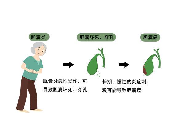 胆囊炎艾灸方法