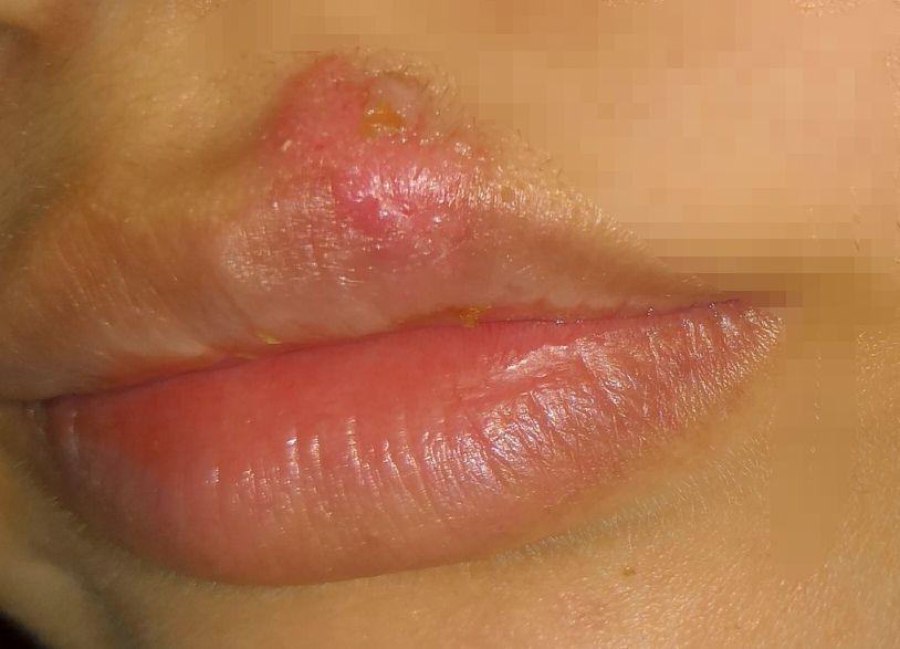 女性嘴周围出很多疹子图片