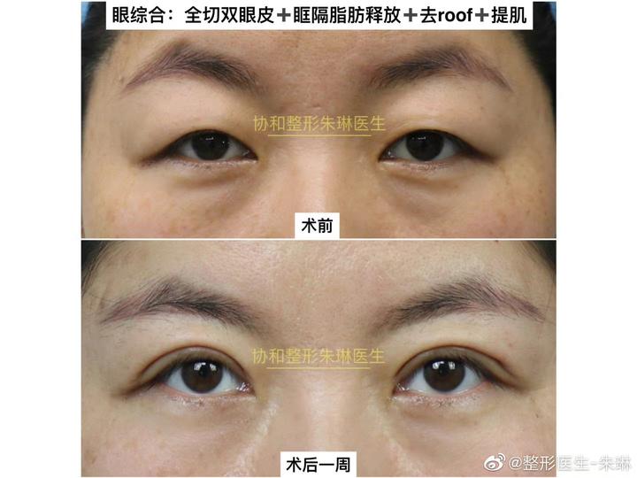 眼综合：全切双眼皮，眶隔脂肪释放，去roof，提肌，术后1周 - 知乎